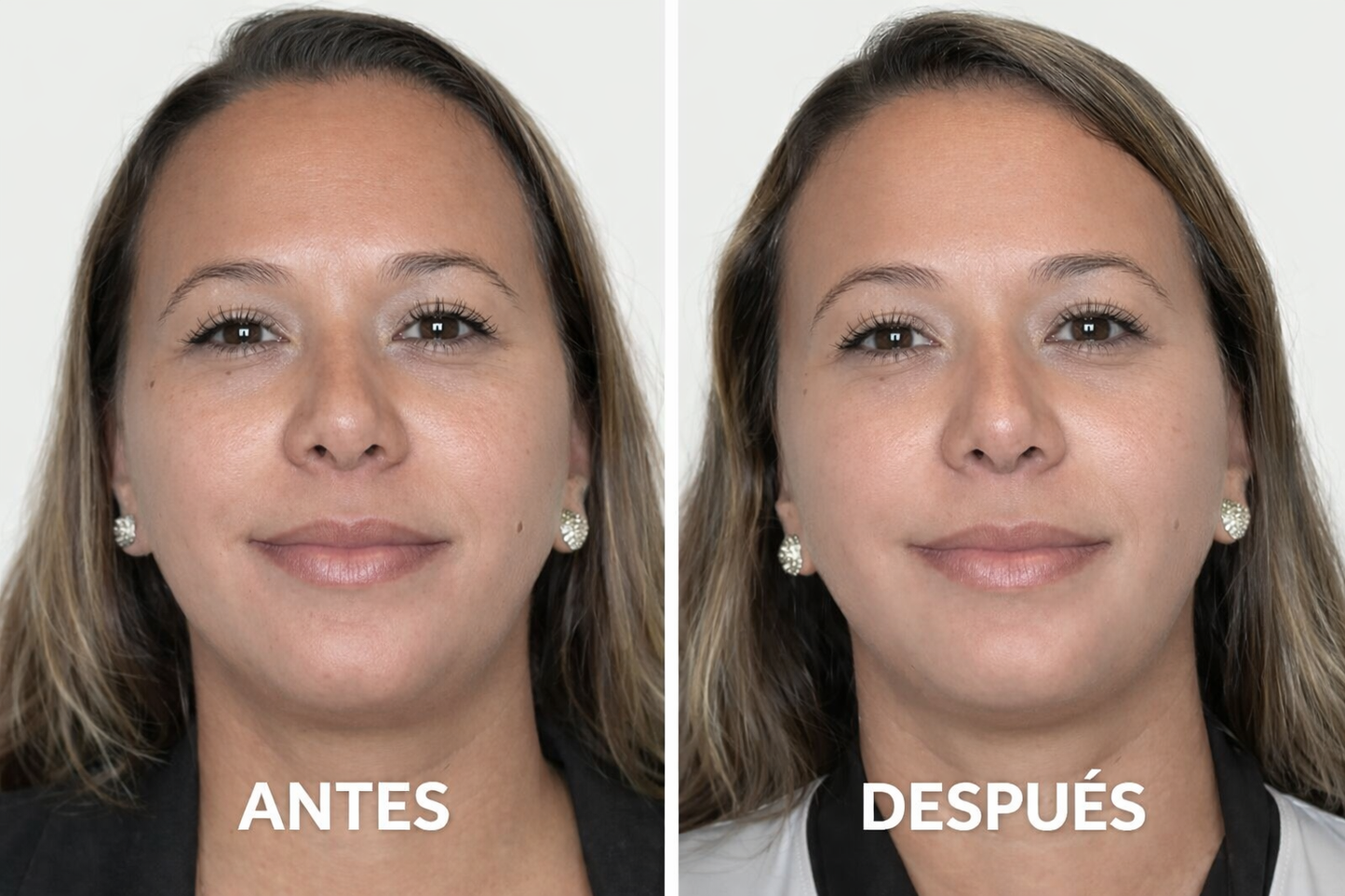 Dispositivo limpieza facial Forever™🧼